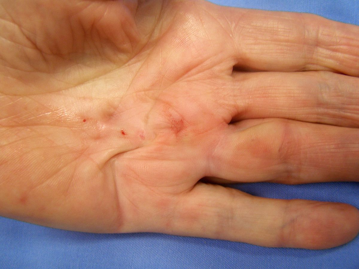 Detailansicht: Fingerkontraktur nach Operation