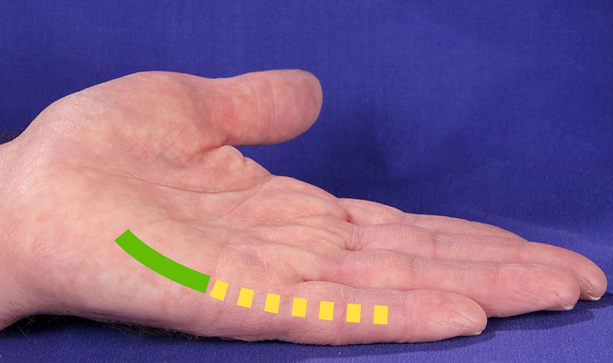 zum Vergrößern klicken Fingerkontraktur