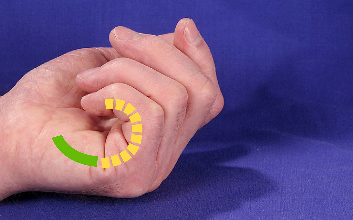 zum Vergrößern klicken Fingerkontraktur