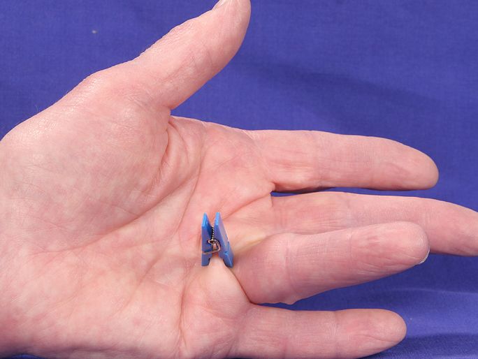 zum Vergrößern klicken Fingerkontraktur
