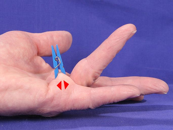 zum Vergrößern klicken Fingerkontraktur