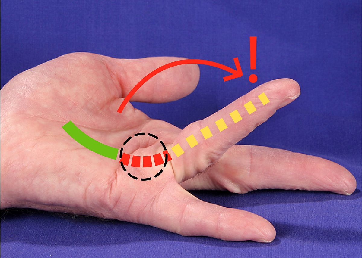 zum Vergrößern klicken Fingerkontraktur